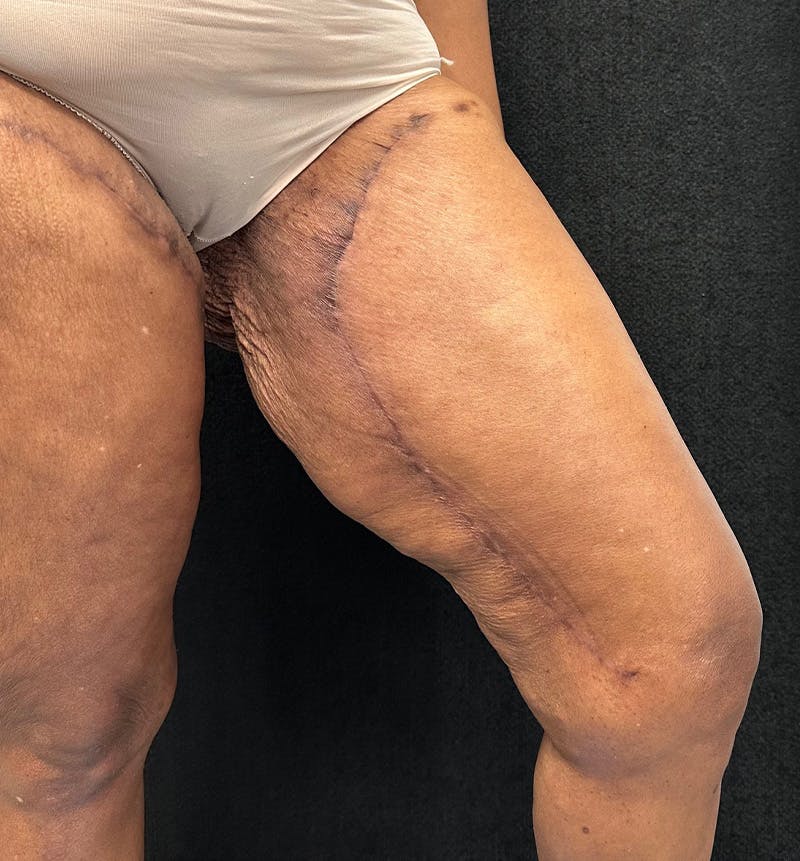 Thigh Lift Before & After Gallery - Patient 385533 - Image 4