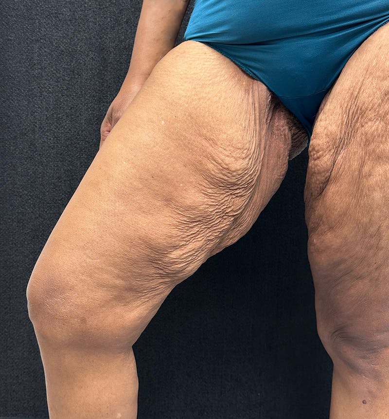 Thigh Lift Before & After Gallery - Patient 385533 - Image 5