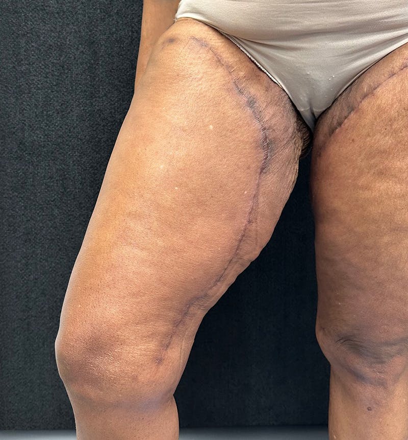 Thigh Lift Before & After Gallery - Patient 385533 - Image 6