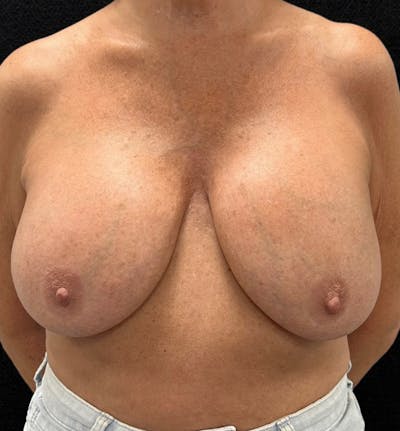 Breast Revision Before & After Gallery - Patient 746091 - Image 1