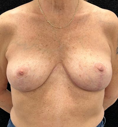 Breast Revision Before & After Gallery - Patient 746091 - Image 2