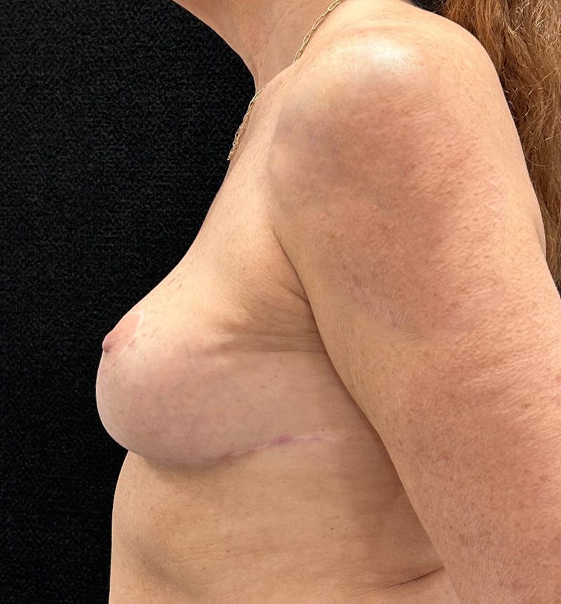 Breast Revision Before & After Gallery - Patient 746091 - Image 10