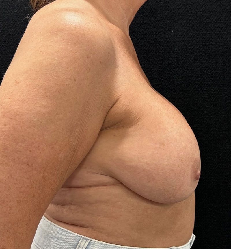 Breast Revision Before & After Gallery - Patient 746091 - Image 5