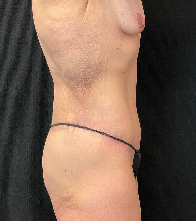 Lower Body Lift Before & After Gallery - Patient 424708 - Image 6