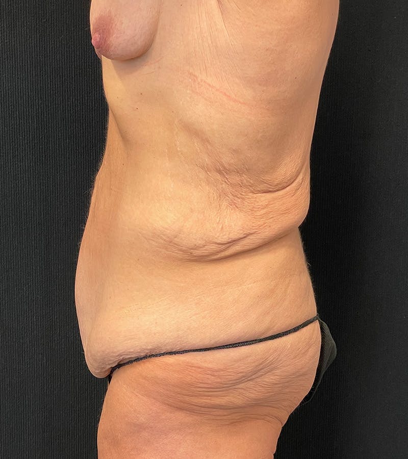 Lower Body Lift Before & After Gallery - Patient 424708 - Image 9
