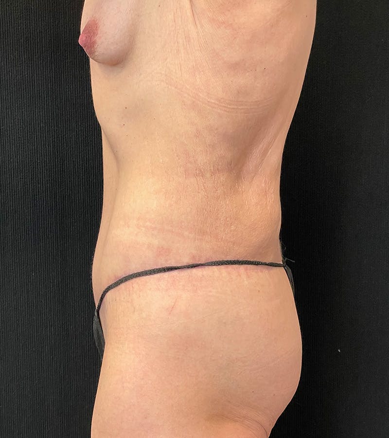 Lower Body Lift Before & After Gallery - Patient 424708 - Image 10