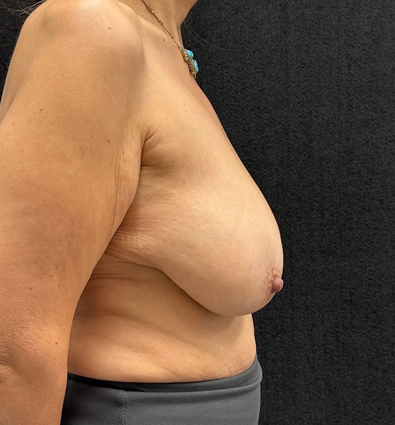 Breast Reduction Before & After Gallery - Patient 656670 - Image 7