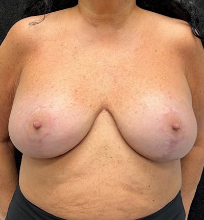 Breast Augmentation Before & After Gallery - Patient 315302 - Image 2