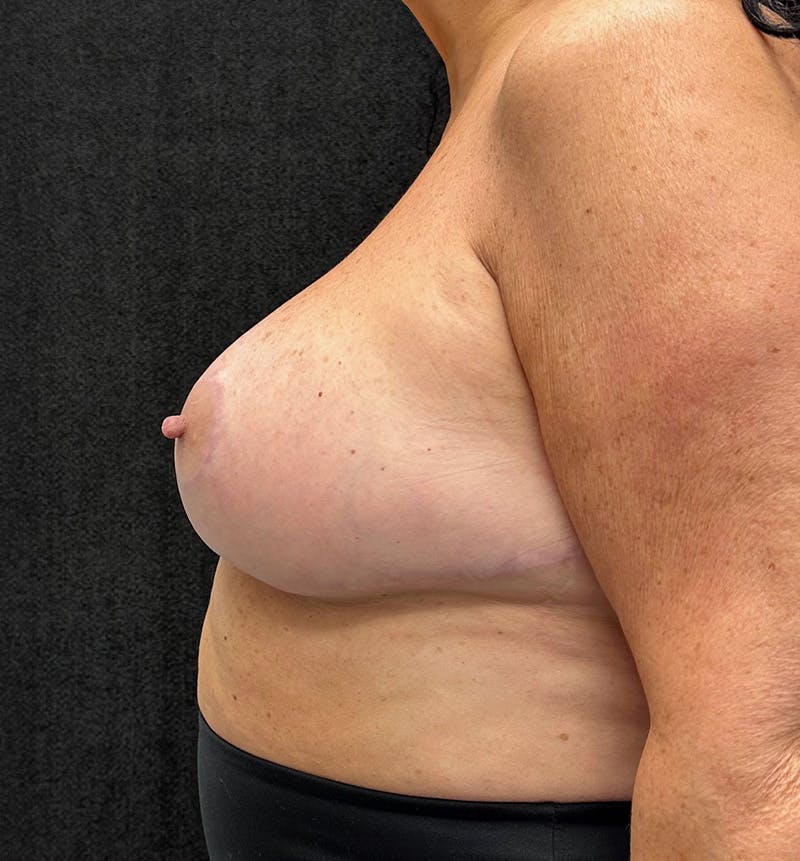 Breast Augmentation Before & After Gallery - Patient 315302 - Image 10