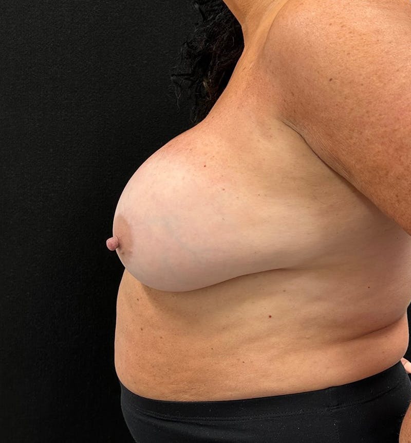 Breast Augmentation Before & After Gallery - Patient 315302 - Image 9