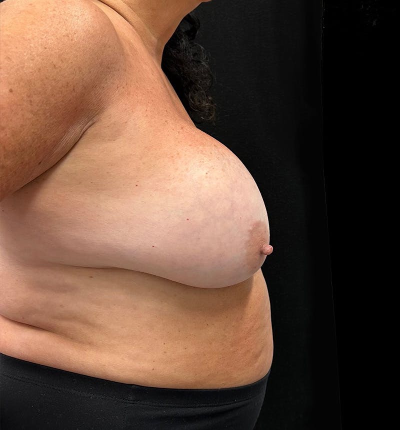 Breast Augmentation Before & After Gallery - Patient 315302 - Image 5