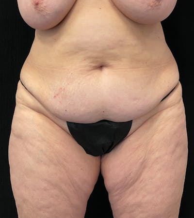 Lower Body Lift Before & After Gallery - Patient 162055 - Image 1