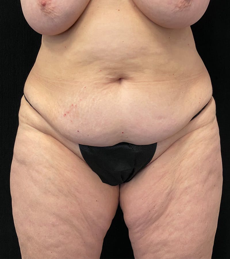 Lower Body Lift Before & After Gallery - Patient 162055 - Image 1