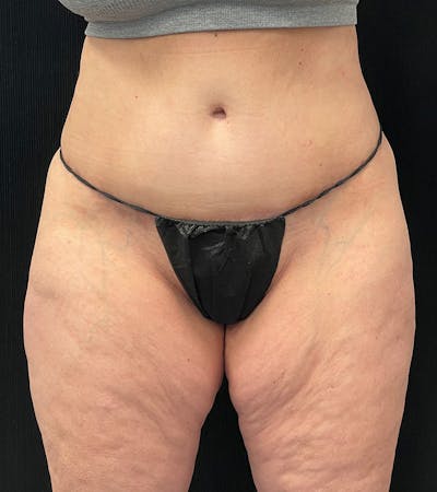 Lower Body Lift Before & After Gallery - Patient 162055 - Image 2