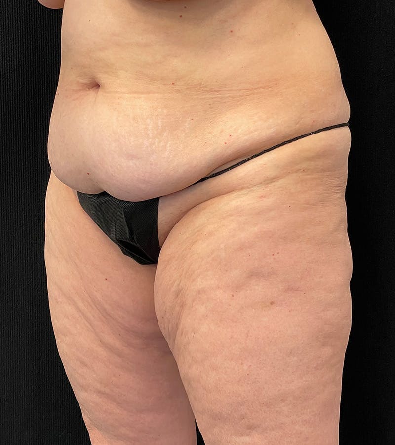Lower Body Lift Before & After Gallery - Patient 162055 - Image 3