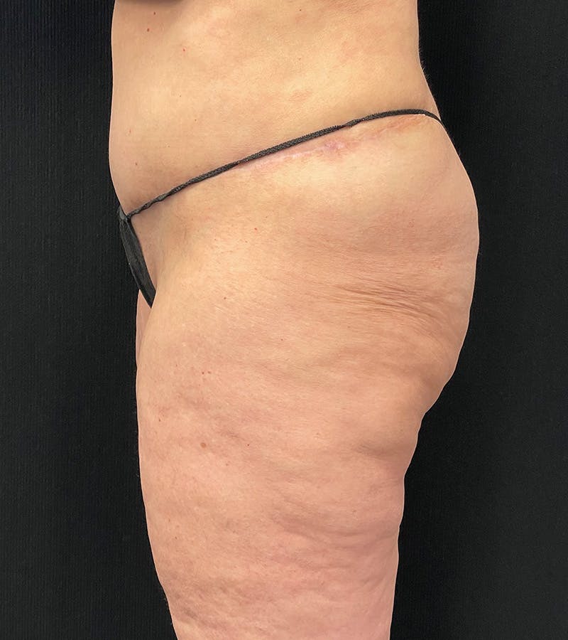 Lower Body Lift Before & After Gallery - Patient 162055 - Image 6
