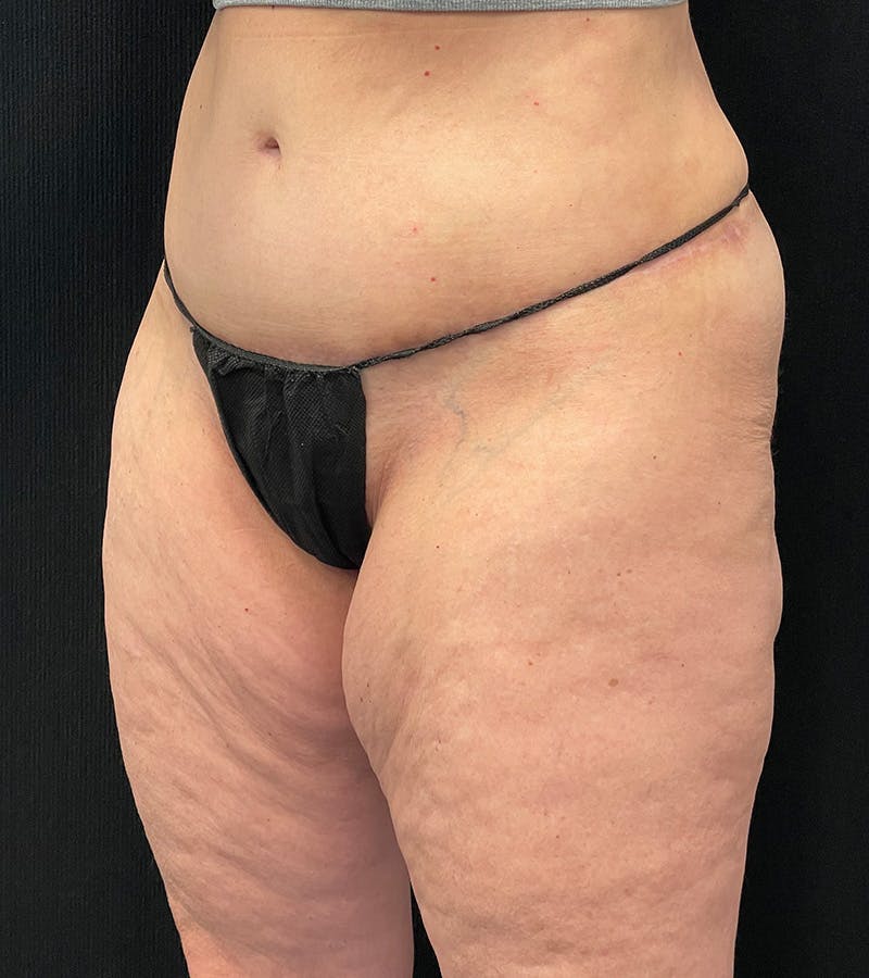 Lower Body Lift Before & After Gallery - Patient 162055 - Image 4