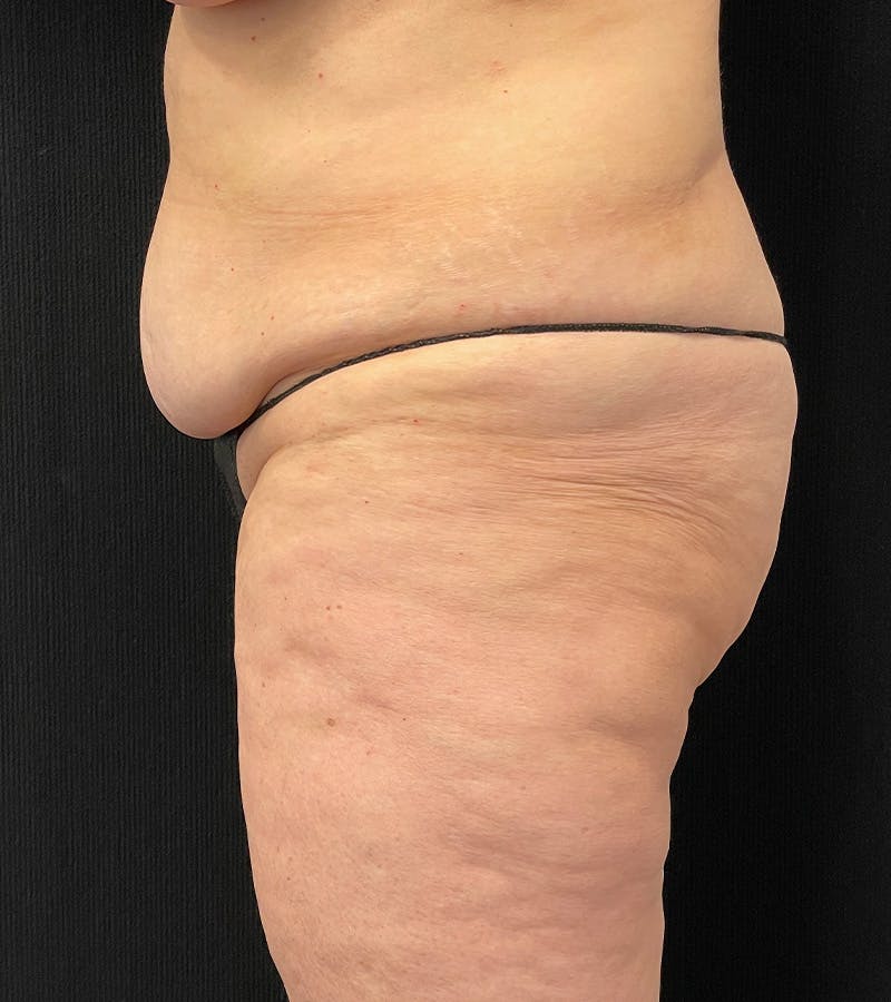 Lower Body Lift Before & After Gallery - Patient 162055 - Image 5
