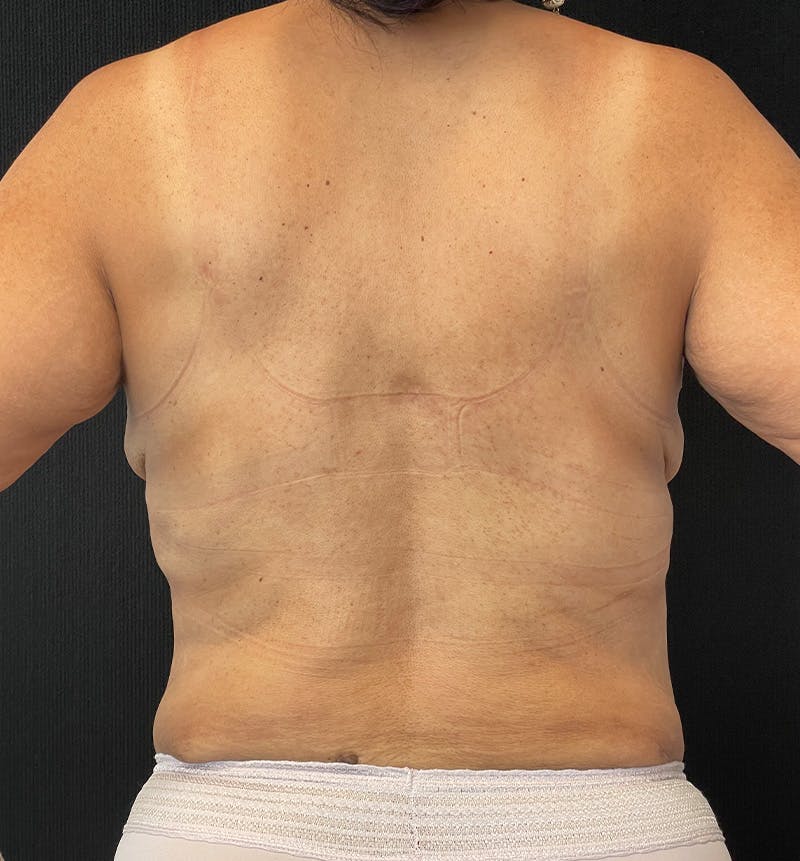Breast Augmentation Before & After Gallery - Patient 274505 - Image 9