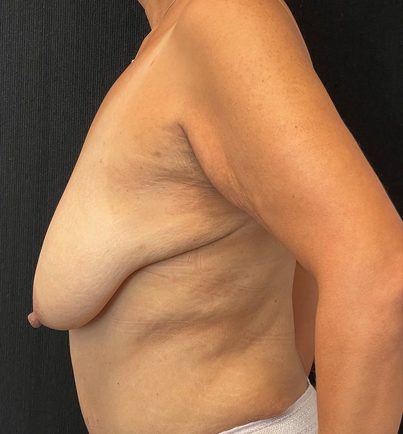 Breast Augmentation Before & After Gallery - Patient 274505 - Image 7