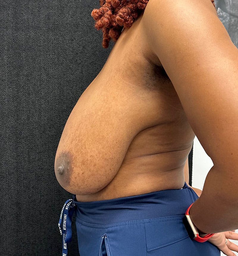 Breast Reduction Before & After Gallery - Patient 320126 - Image 5