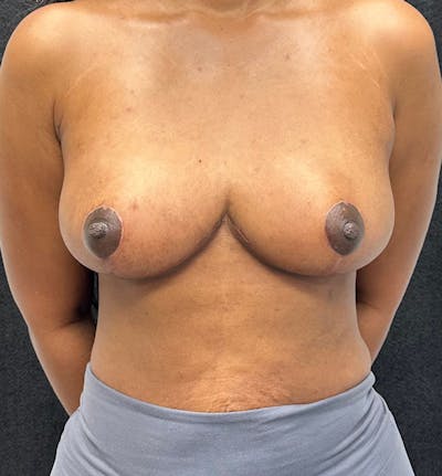 Breast Reduction Before & After Gallery - Patient 320126 - Image 2