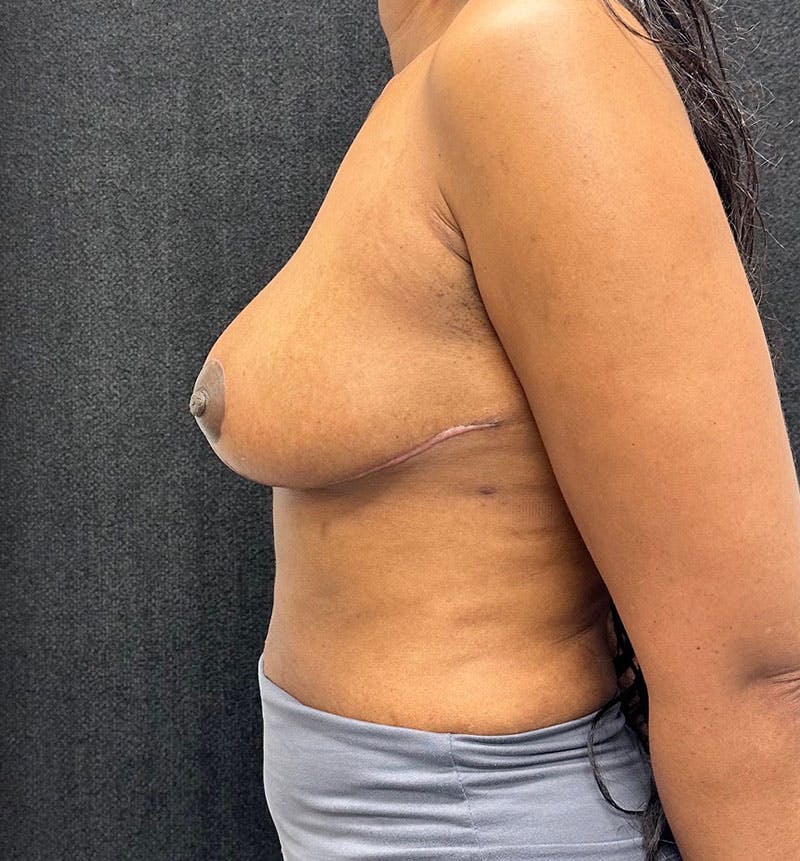 Breast Reduction Before & After Gallery - Patient 320126 - Image 6