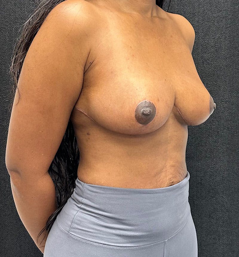 Breast Reduction Before & After Gallery - Patient 320126 - Image 10