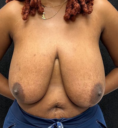 Breast Reduction Before & After Gallery - Patient 320126 - Image 1
