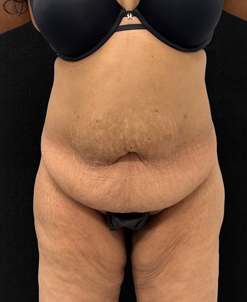 Abdominoplasty Before & After Gallery - Patient 181262 - Image 1