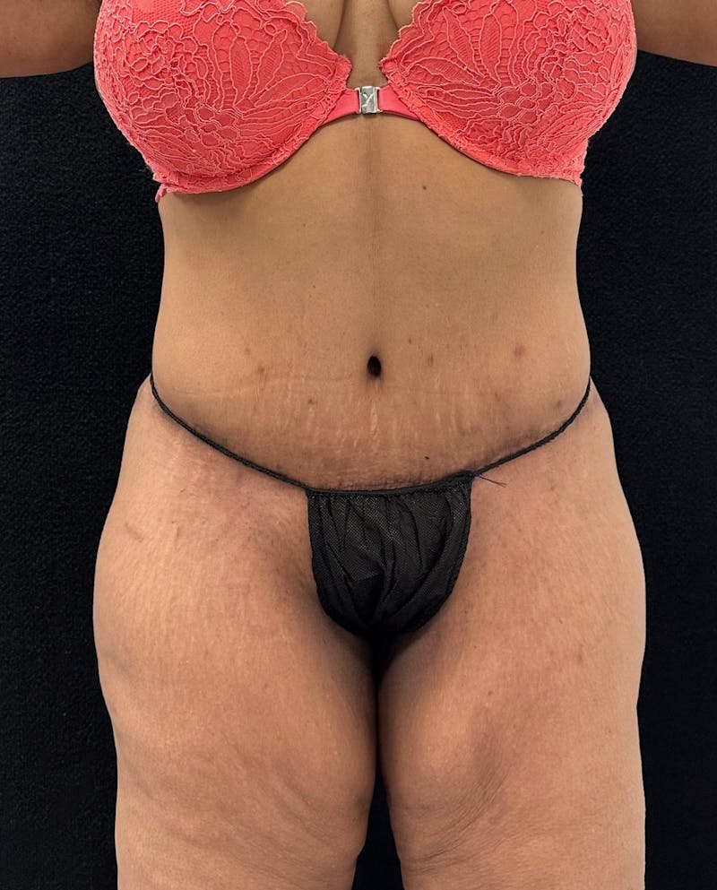 Abdominoplasty Before & After Gallery - Patient 181262 - Image 2