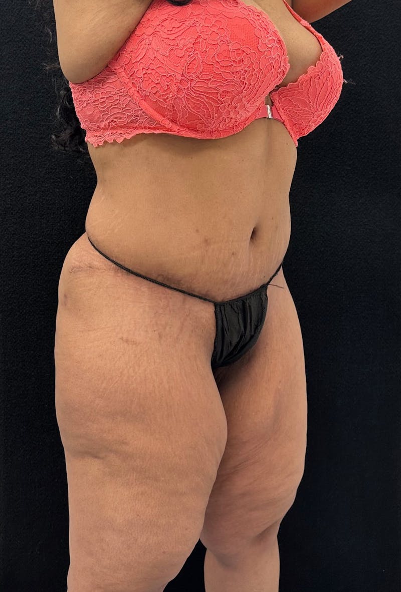 Abdominoplasty Before & After Gallery - Patient 181262 - Image 4
