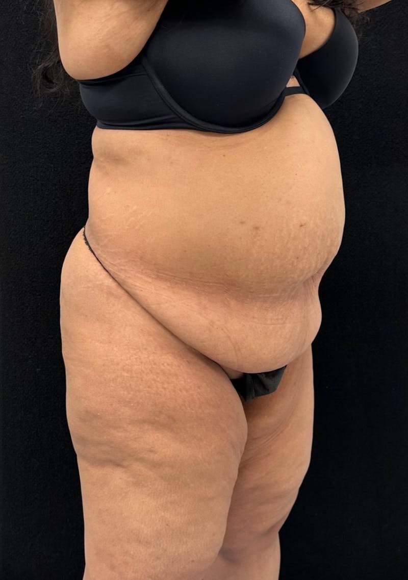 Abdominoplasty Before & After Gallery - Patient 181262 - Image 3