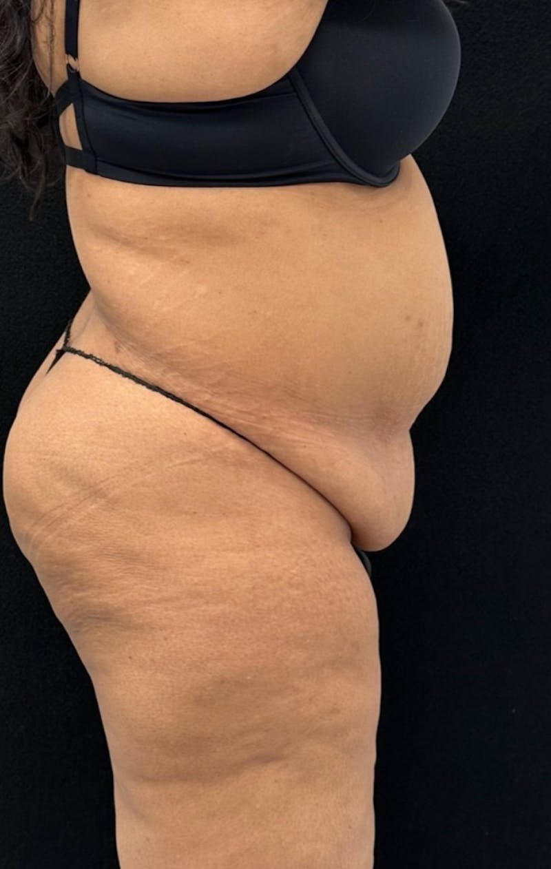 Abdominoplasty Before & After Gallery - Patient 181262 - Image 5
