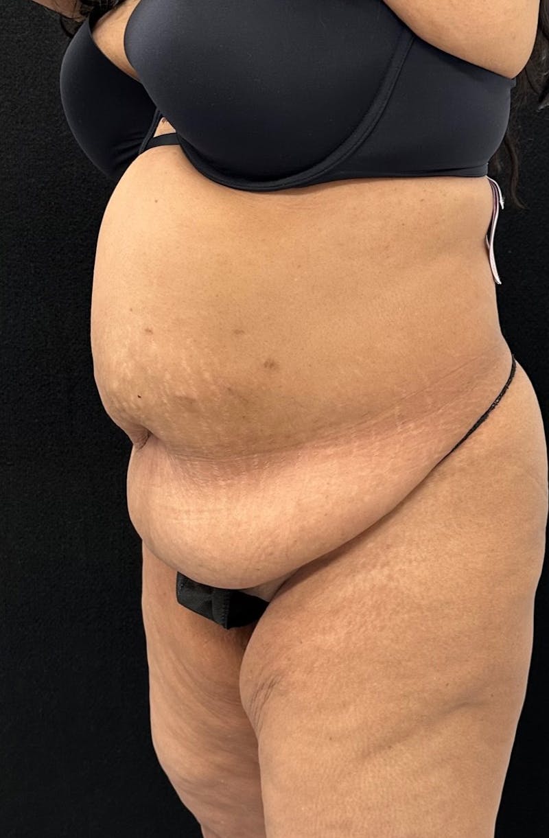 Abdominoplasty Before & After Gallery - Patient 181262 - Image 7