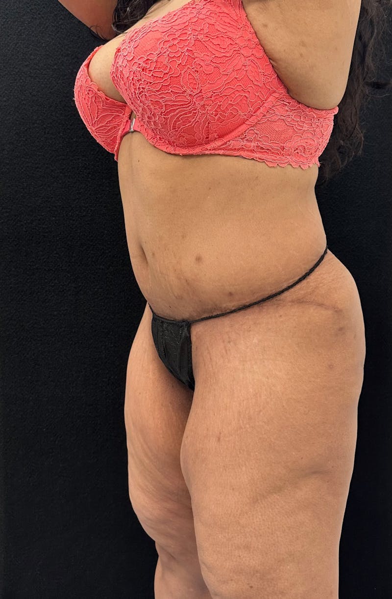 Abdominoplasty Before & After Gallery - Patient 181262 - Image 8