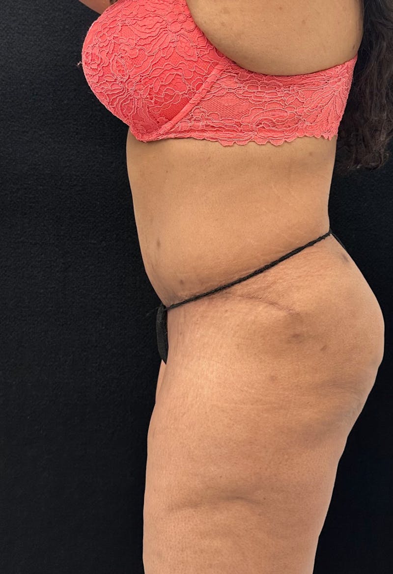 Abdominoplasty Before & After Gallery - Patient 181262 - Image 10