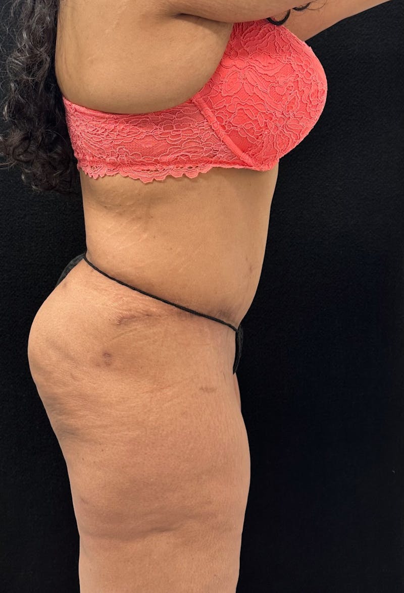 Abdominoplasty Before & After Gallery - Patient 181262 - Image 6