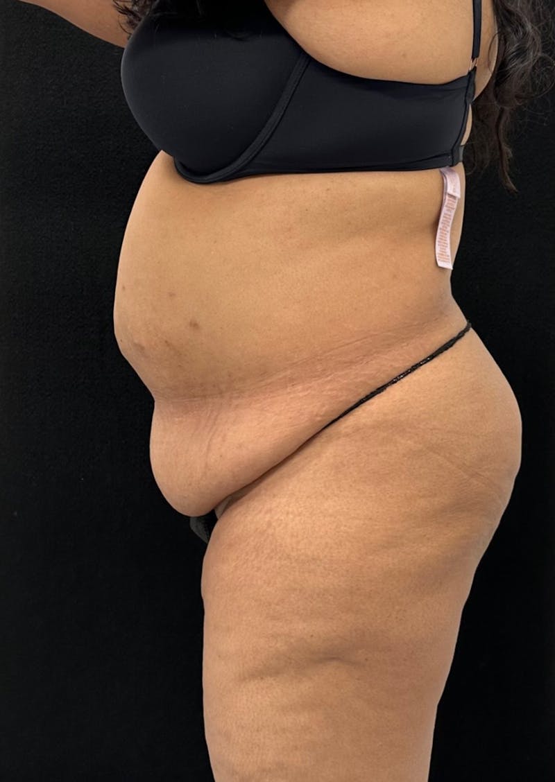 Abdominoplasty Before & After Gallery - Patient 181262 - Image 9