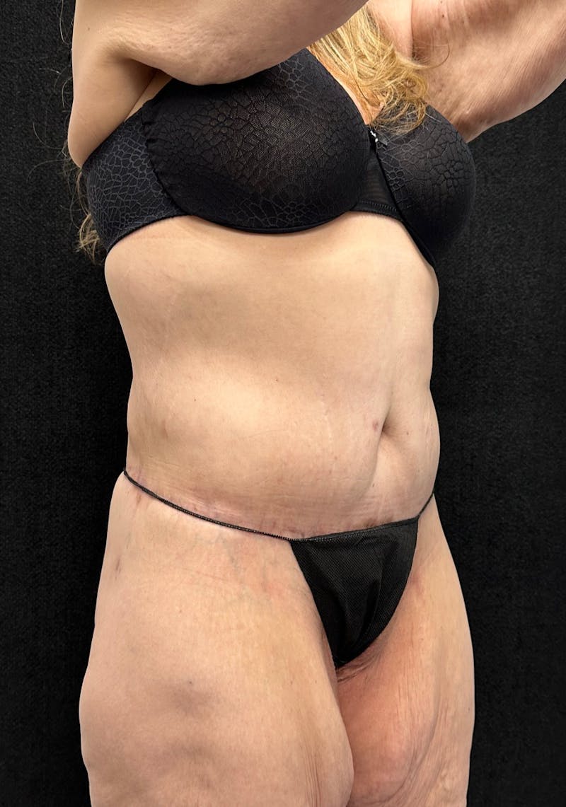 Lower Body Lift Before & After Gallery - Patient 339462 - Image 6
