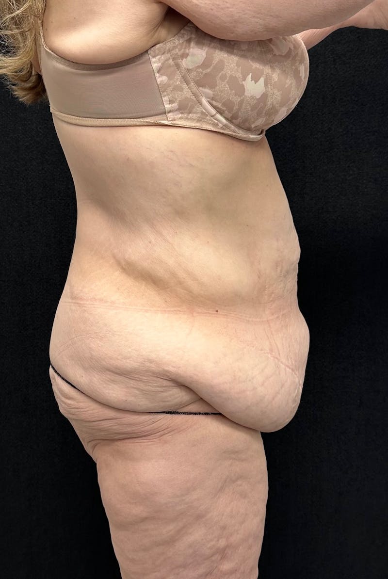 Lower Body Lift Before & After Gallery - Patient 339462 - Image 7