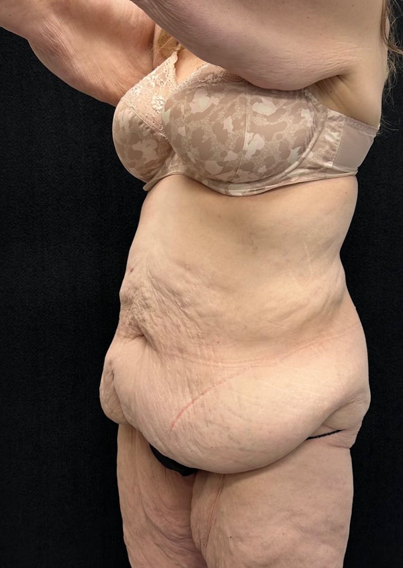 Lower Body Lift Before & After Gallery - Patient 339462 - Image 11