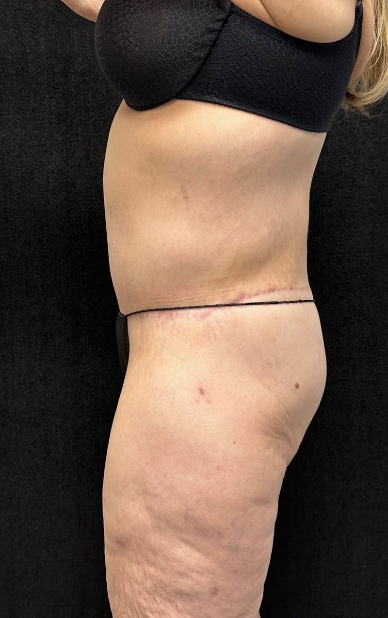 Lower Body Lift Before & After Gallery - Patient 339462 - Image 4