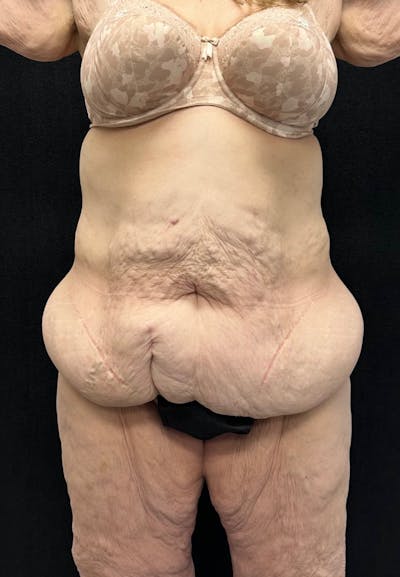 Lower Body Lift Before & After Gallery - Patient 339462 - Image 1