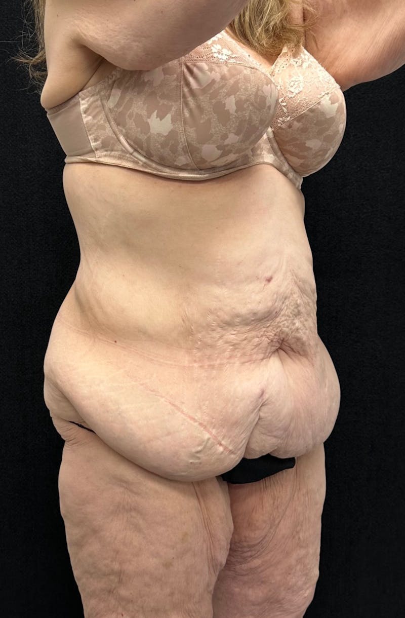 Lower Body Lift Before & After Gallery - Patient 339462 - Image 5