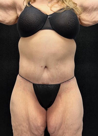 Lower Body Lift Before & After Gallery - Patient 339462 - Image 2