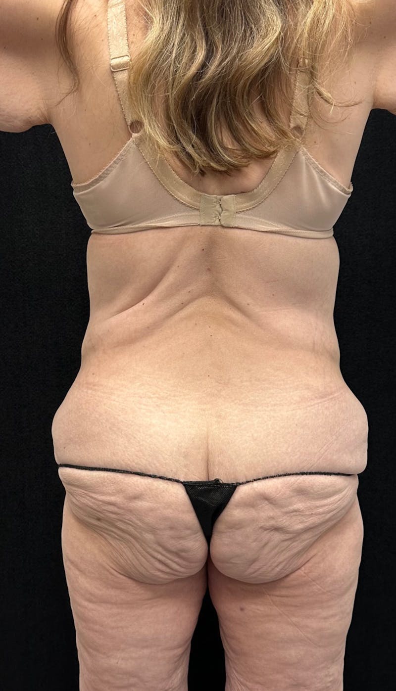 Lower Body Lift Before & After Gallery - Patient 339462 - Image 9