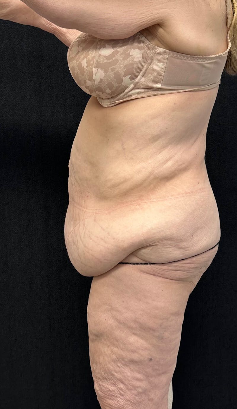 Lower Body Lift Before & After Gallery - Patient 339462 - Image 3