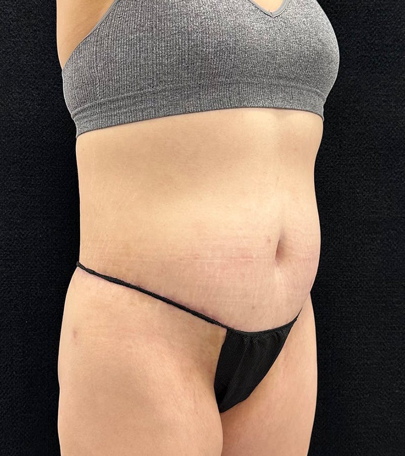 Lower Body Lift Before & After Gallery - Patient 720624 - Image 4
