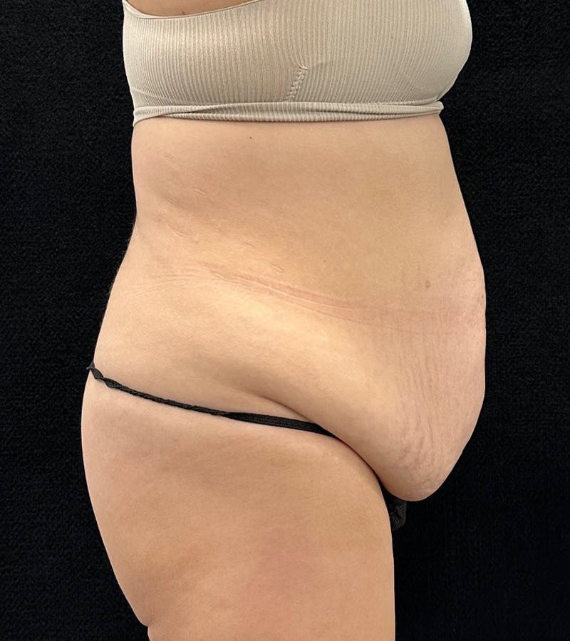 Lower Body Lift Before & After Gallery - Patient 720624 - Image 5